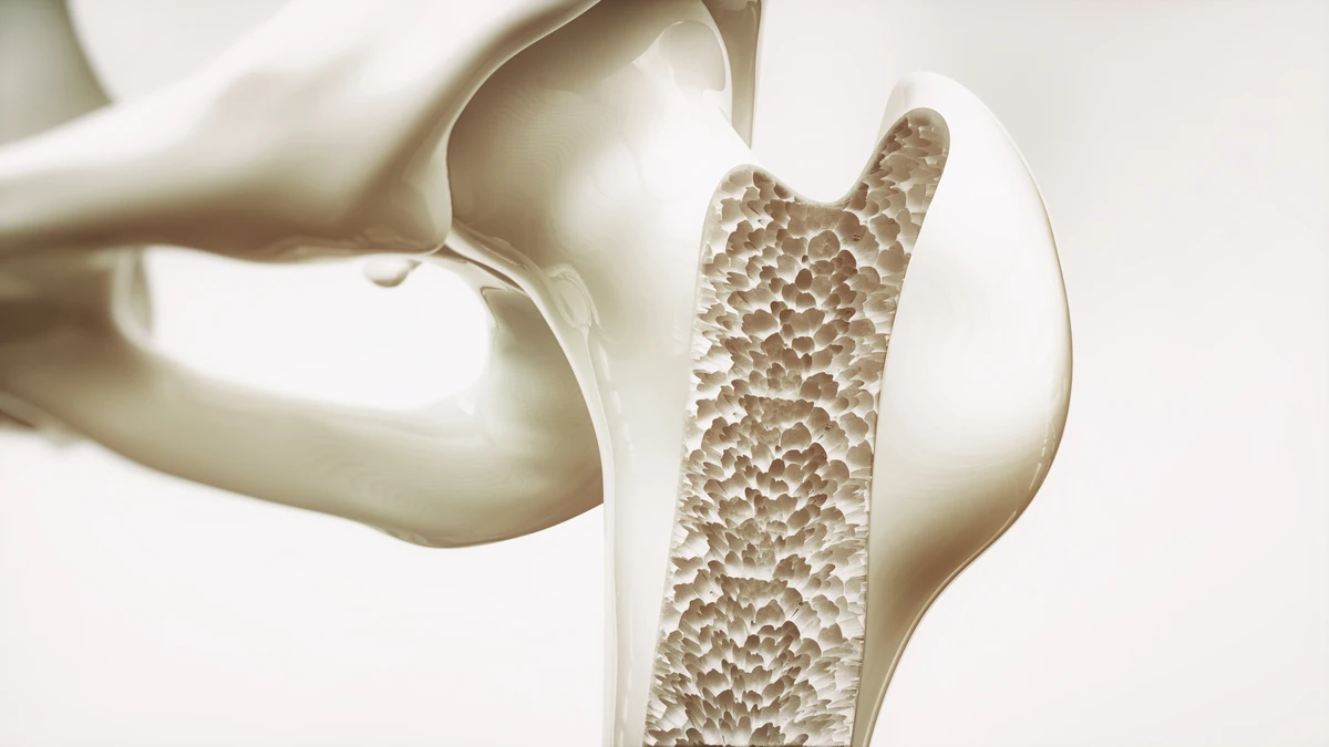 Osteoporosis stage 4 of 4 - upper limb bones