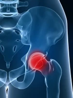 Anatomische Darstellung des Hüftgelenks mit schmerzhafter Arthrose