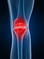 Anatomische Darstellung des Kniegelenks mit Arthrose